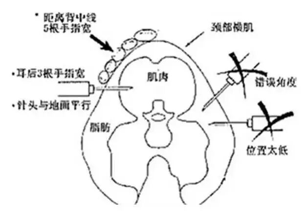 疫苗、药品注射不当引发的应激反应，要重视起来！